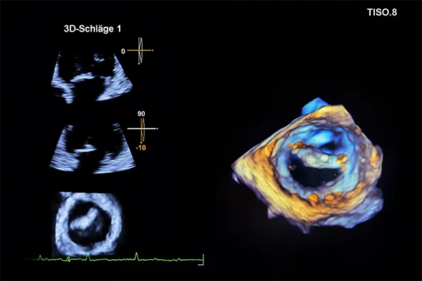 Aufnahme einer Herzklappe eines Ultraschallgerätes